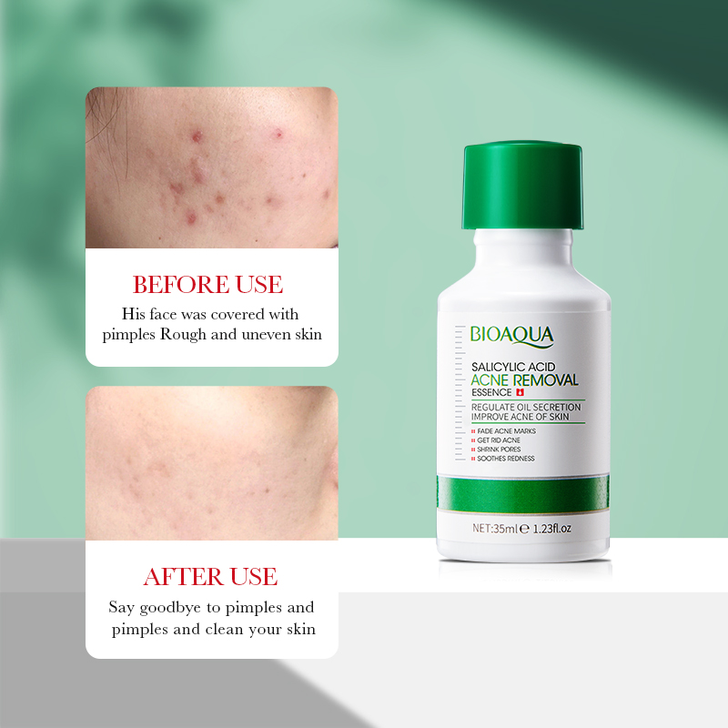 35 مللي BIOAOUA حمض الساليسيلي - مراجعة Azelaic Acid Serum وسعره